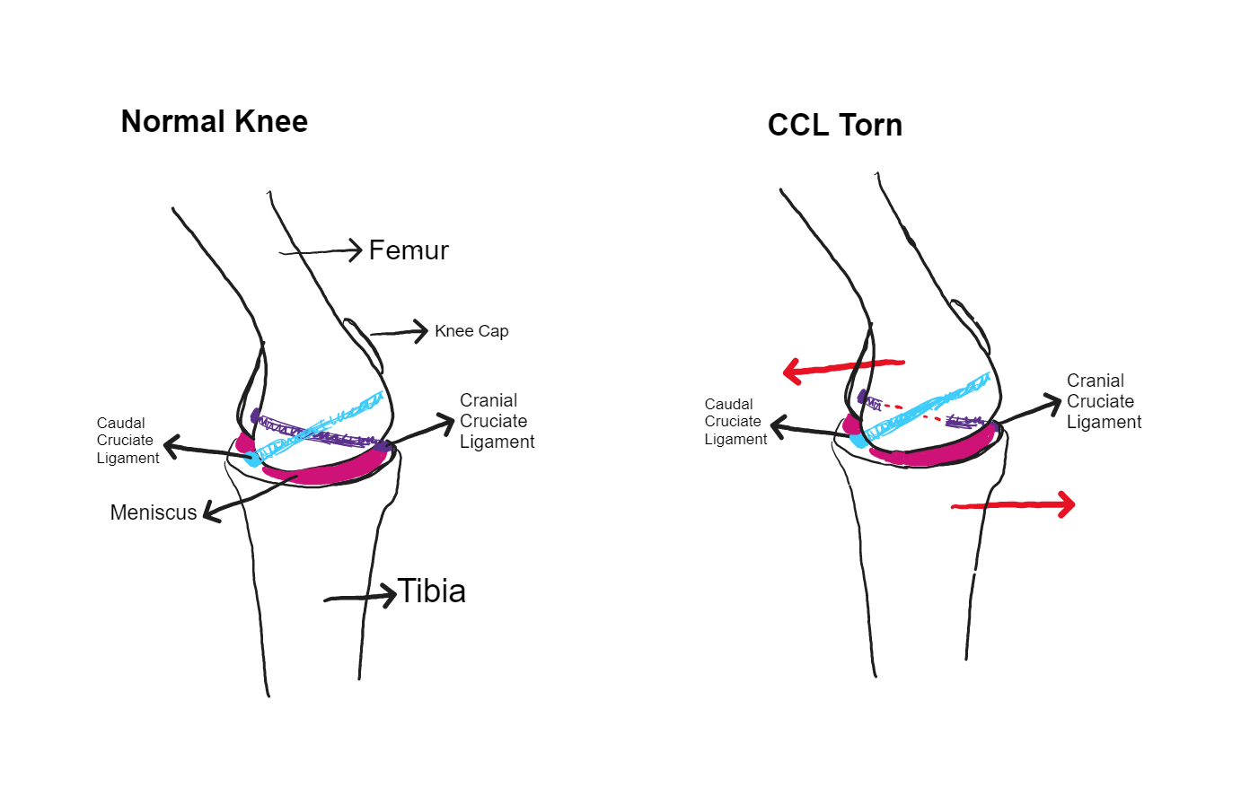 Normal vs Torn CCL Figure 1 - Normal vs Torn CCL